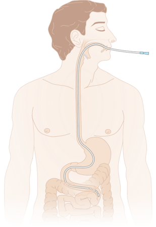 Зонд (катетер) дуоденальный с РКП MEDEREN 125 см закрытый конец 