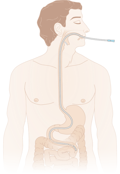 Зонд (катетер) дуоденальный с РКП MEDEREN 125 см закрытый конец  Зонд (катетер) дуоденальный с РКП MEDEREN 125 см закрытый конец